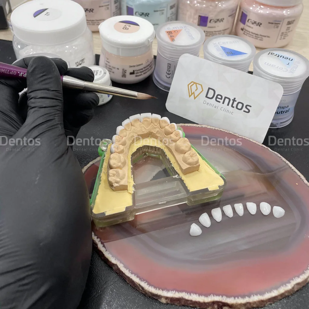 Mặt dán sứ Veneer đem lại thẩm mỹ tuyệt vời nhưng vẫn bảo tồn tối đa răng thật